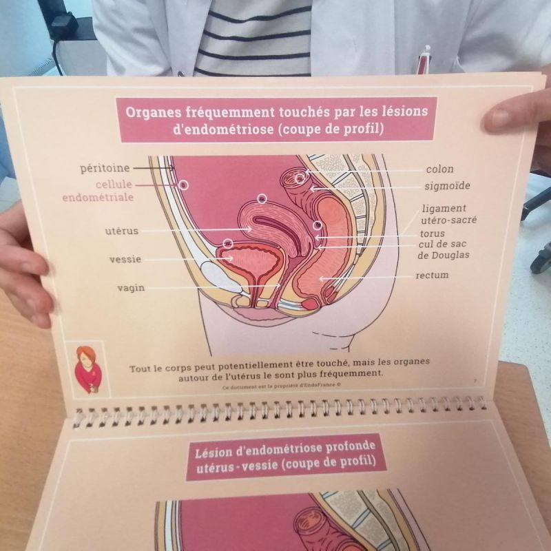 La Nouvelle-Aquitaine à la pointe de la lutte contre l'endométriose
