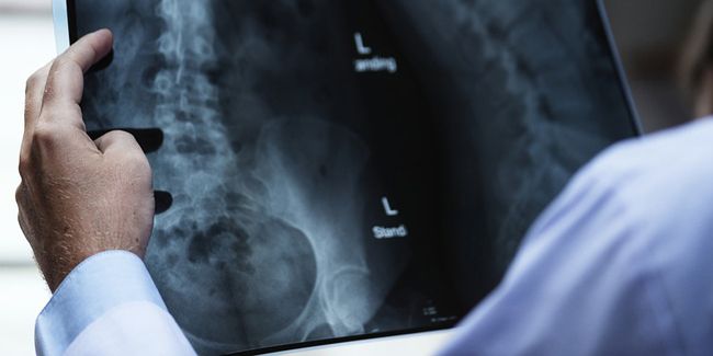 Fracture du col du fémur : opérer ou non ? Ce que vous devez savoir